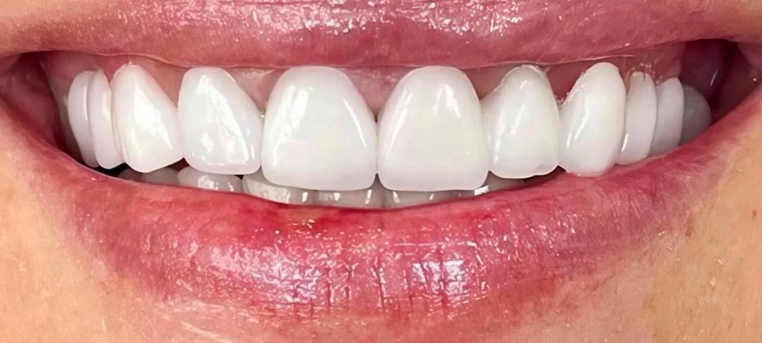 The same patient after treatment: a complete, even upper arch